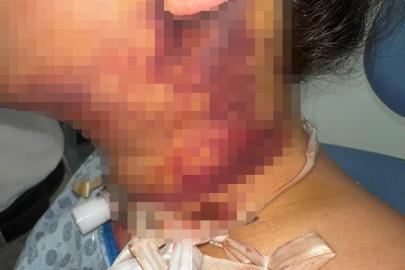Estetik ameliyatı sonrası yoğun bakımda 2 gün tedavi gördü, doktor hakkında şikayetçi oldu